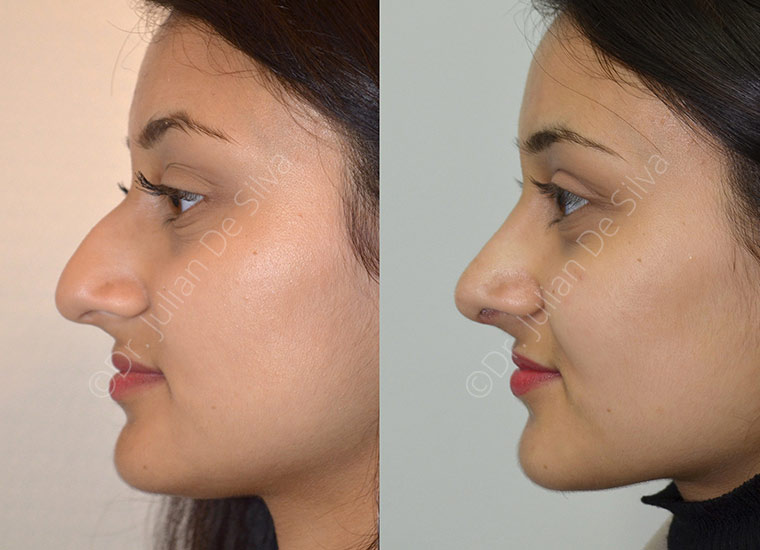 Rhinoplasty Patient 30