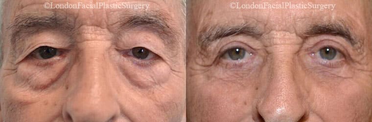 Blepharoplasty Patient 32