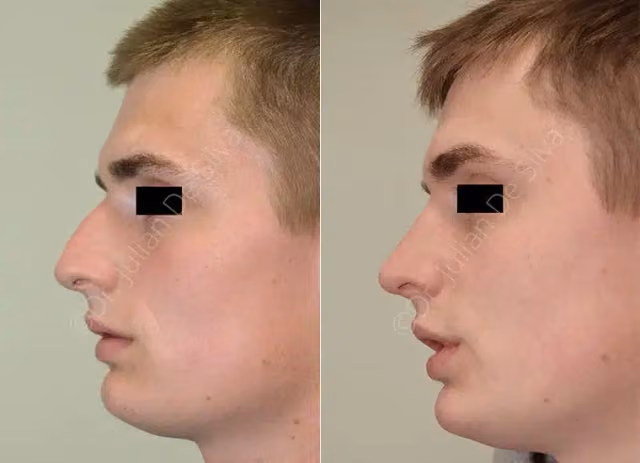 Revision Rhinoplasty Patient 3
