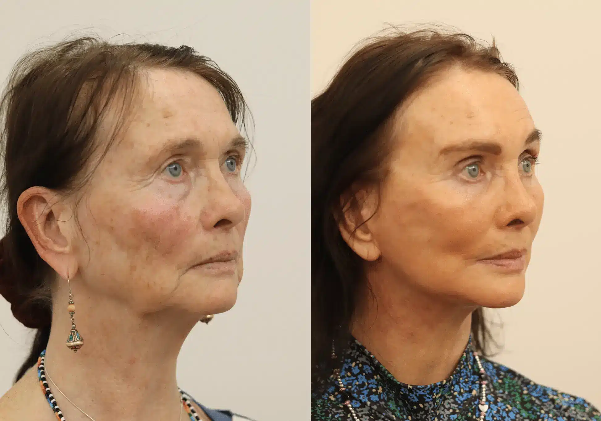A refreshed, natural transformation. This lovely patient underwent Dr. Julian De Silva’s signature facelift, neck lift, and fat transfer to restore youthful volume, smooth loose skin, and redefine her jawline—achieving a beautifully rejuvenated look witho