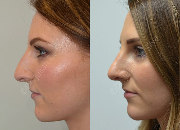 Rhinoplasty Patient 25