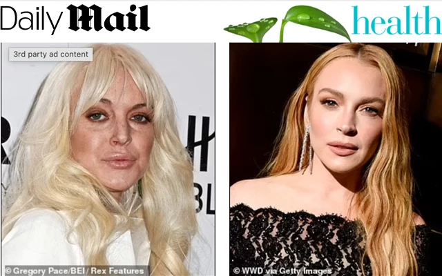 Daily Mail: Rise in Facelifts Among Younger Women