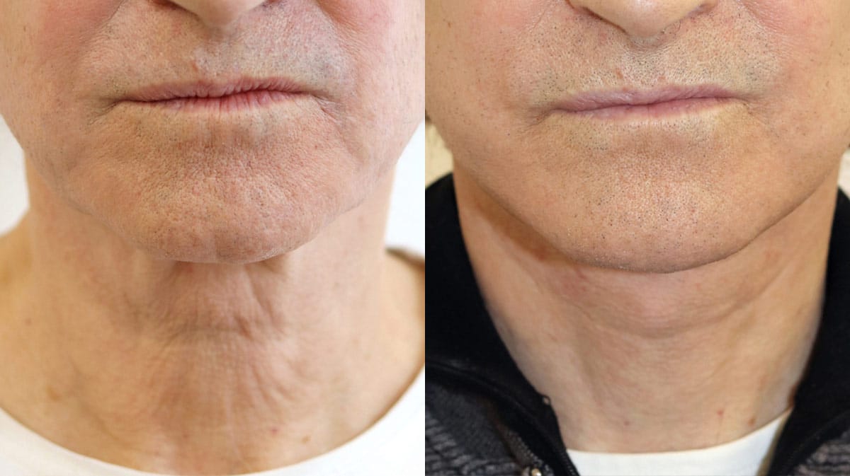 Natural Brow Lift and Forehead Lift Surgery in Harley Street, London | Dr Julian De Silva image 6