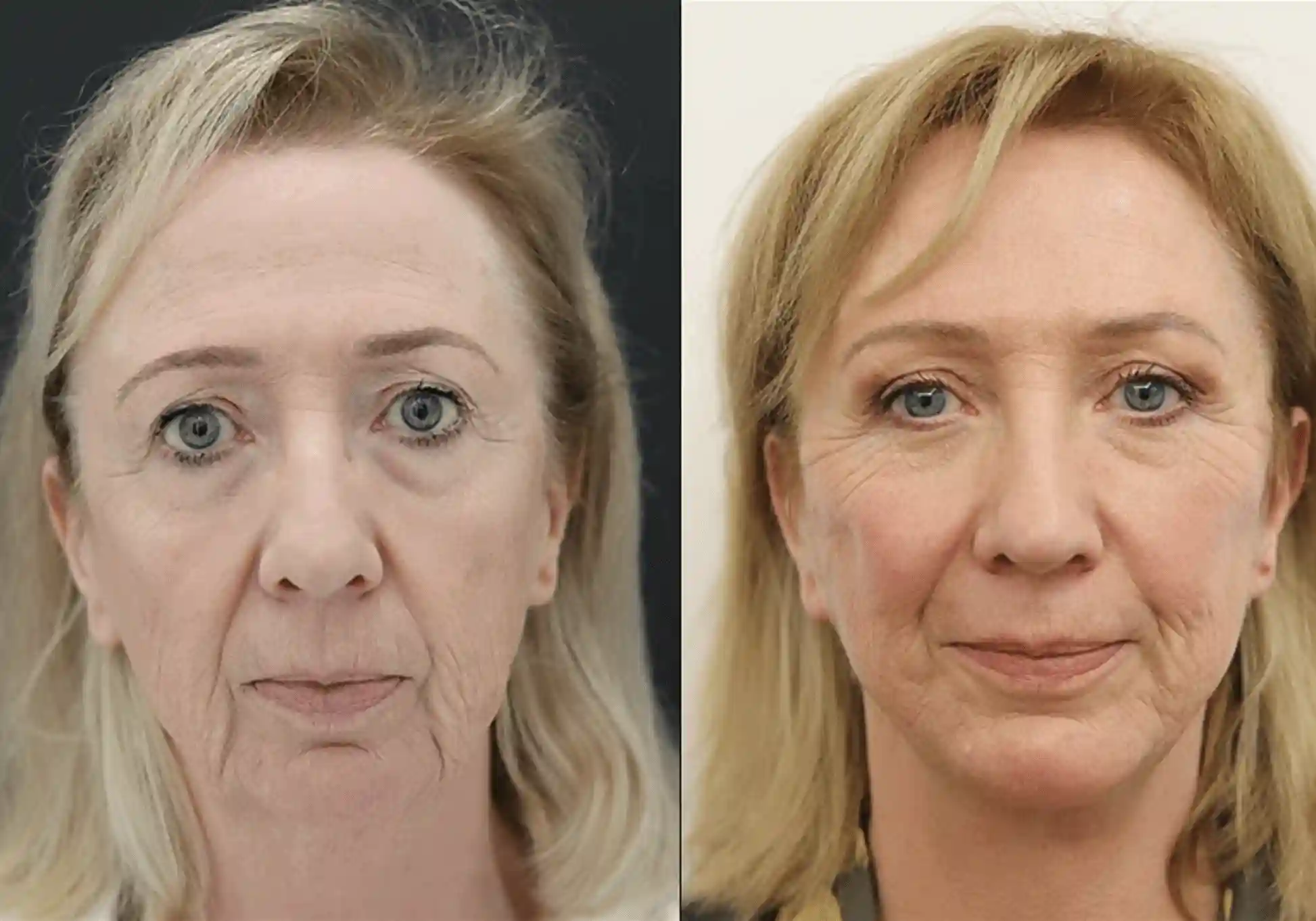 Patient face, before and after Facelift treatment, front view, patient 1